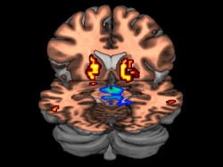 Impulsive Behavior Brain Image